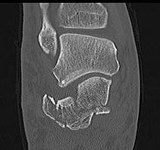 Calcaneal Fracture Sanders 3 CT